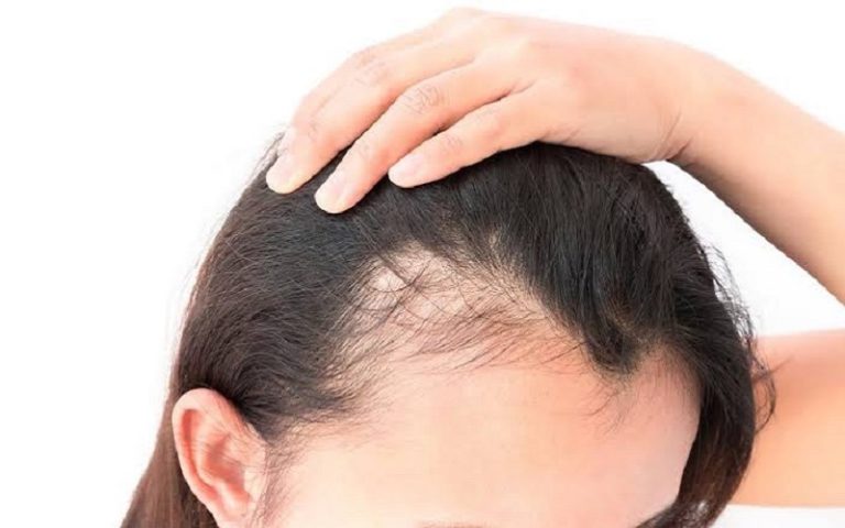 Hair Loss Treatment in Ahmedabad